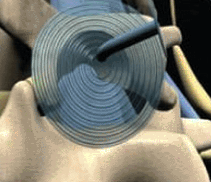 Image: The SpineShield Antiadhesion Device (photo courtesy  Magen Medical Solutions).